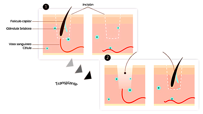 trasplante-capilar-tecnica-fue